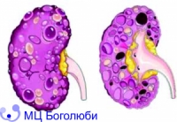 Multicystic kidney disease