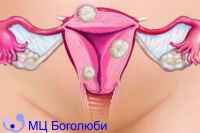 Хірургія фіброміоми матки
