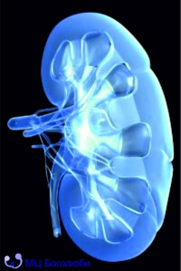 Kidney stone disease (Bilateral renal calculi / urolithiasis)