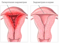 Endometrial hyperplasia