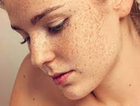 PIGMENT SPOTS: WHAT YOU NEED TO KNOW?