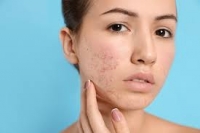 Cystic acne: how to recognize and help?
