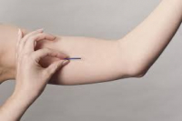 Subdermal contraceptive implants: what are they and how do they work?