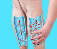 Венозна недостатність: що це таке і чим допомогти?