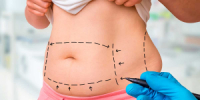 Liposuction: benefits and risks of the procedure