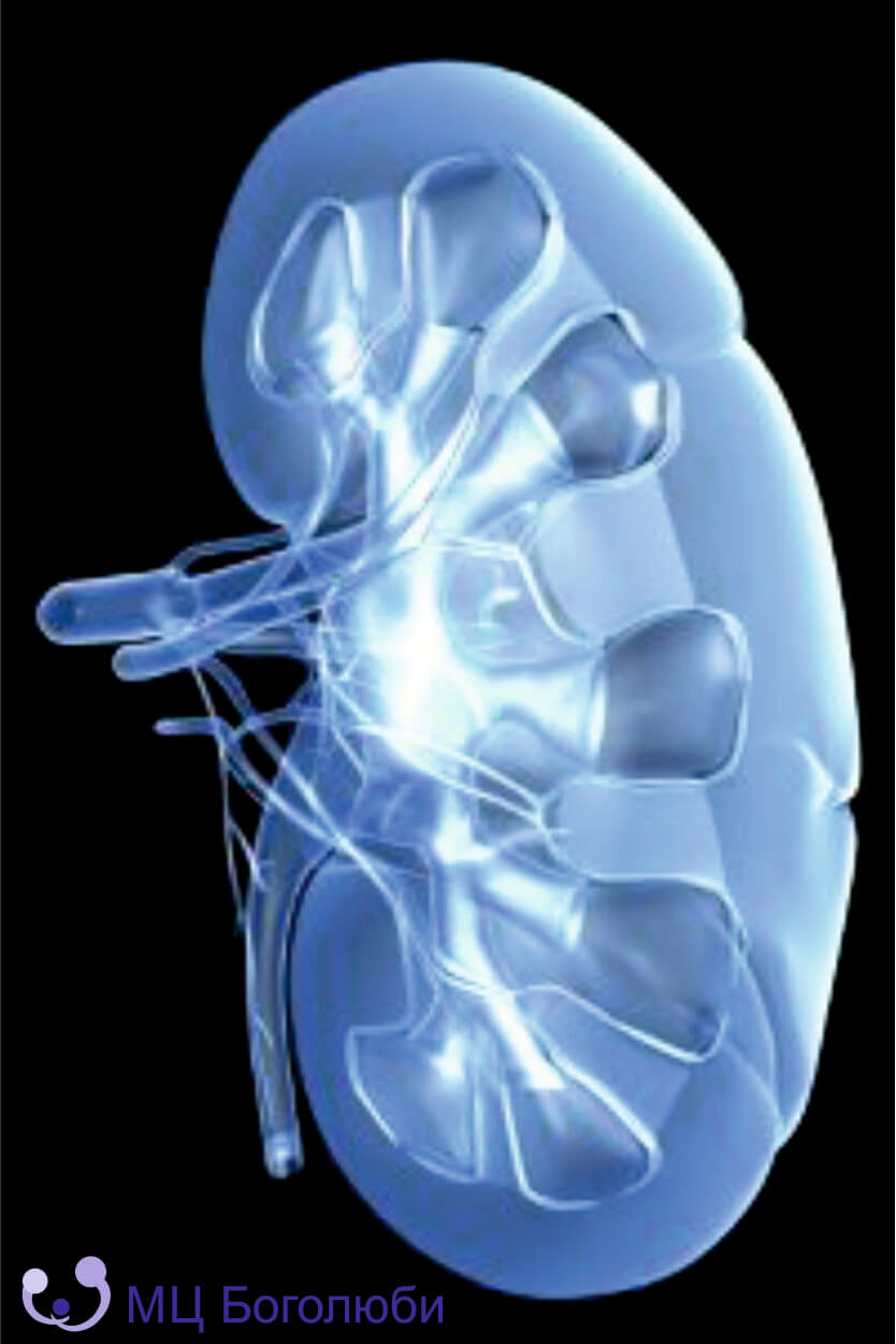 Kidney stone disease (Bilateral renal calculi / urolithiasis), фото