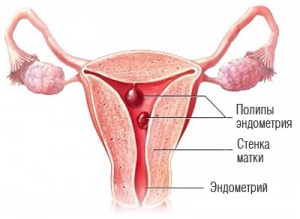 Endometrial polyps, фото