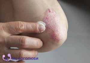 How to treat psoriasis, фото