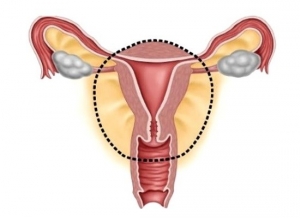 Hysterectomy, фото