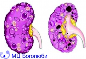 Multicystic kidney disease, фото