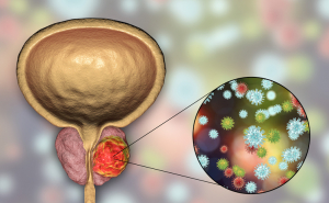 Prostate Cancer: Why Are the Early Stages So Hard to Notice?, фото