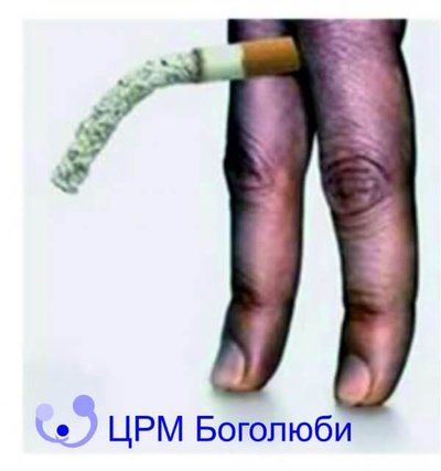 Хвороба Пейроні