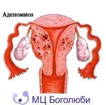 Аденоміоз