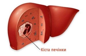 Кіста печінки