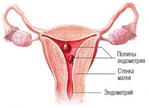 Поліп ендометрію