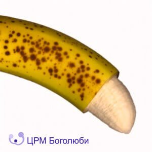 Фімоз